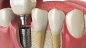 ایمپلنت دندان چیست؟ (+مراحل، مزایا و عمر) 15