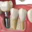 ایمپلنت دندان چیست؟ (+مراحل، مزایا و عمر) 23