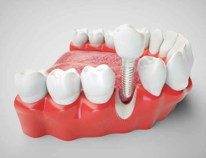 ایمپلنت دندان چیست؟ (+مراحل، مزایا و عمر) 9