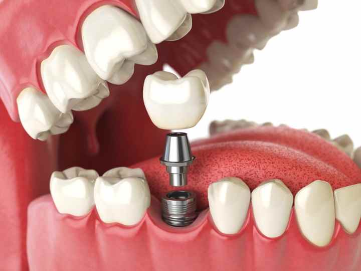 ایمپلنت دندان چیست؟ (+مراحل، مزایا و عمر) 11